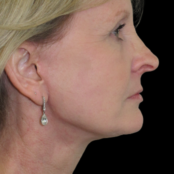 after deep-plane-facelift-laser-resurfacing